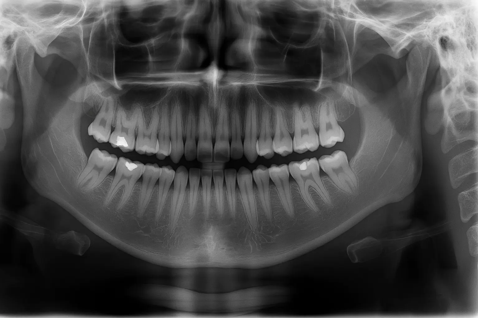 OPG Digital Dental X-Ray
